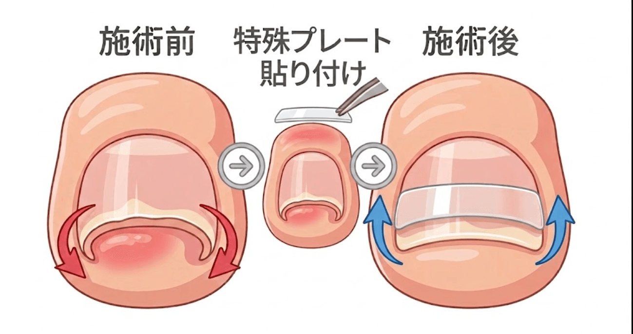 プレート矯正の施術イメージ
